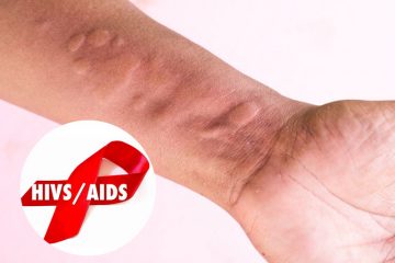 DẤU HIỆU NHẬN BIẾT BẠN CÓ THỂ ĐÃ BỊ HIV VÀ XÉT NGHIỆM HỖ TRỢ ĐIỀU TRỊ